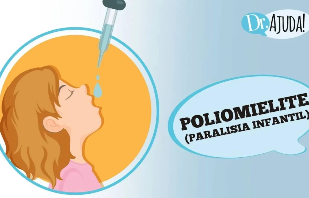 poliomielite:-paralisia-infantil