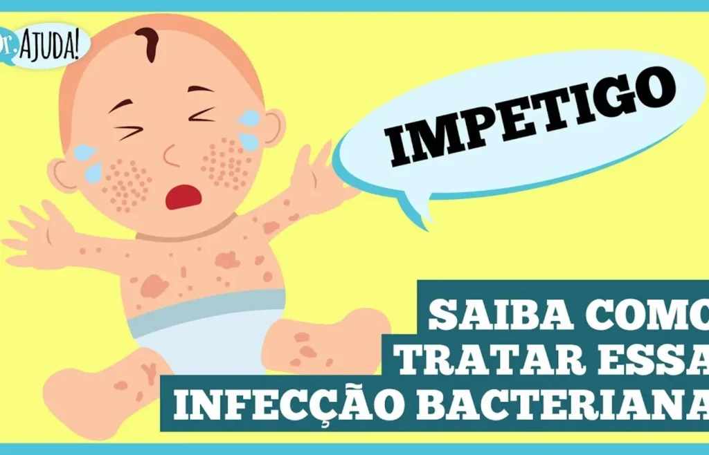 impetigo:-a-infeccao-de-pele-comum-em-criancas!-saiba-como-tratar