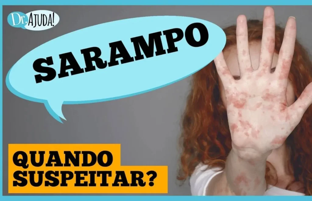 sarampo:-quando-suspeitar