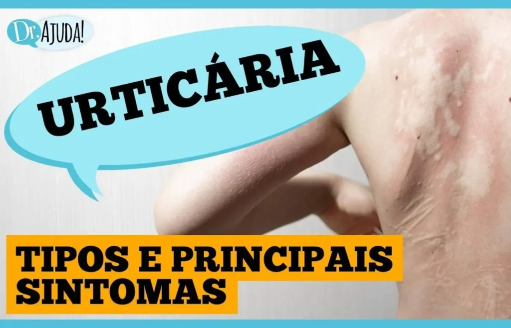manchas-vermelhas-na-pele:-pode-ser-urticaria?
