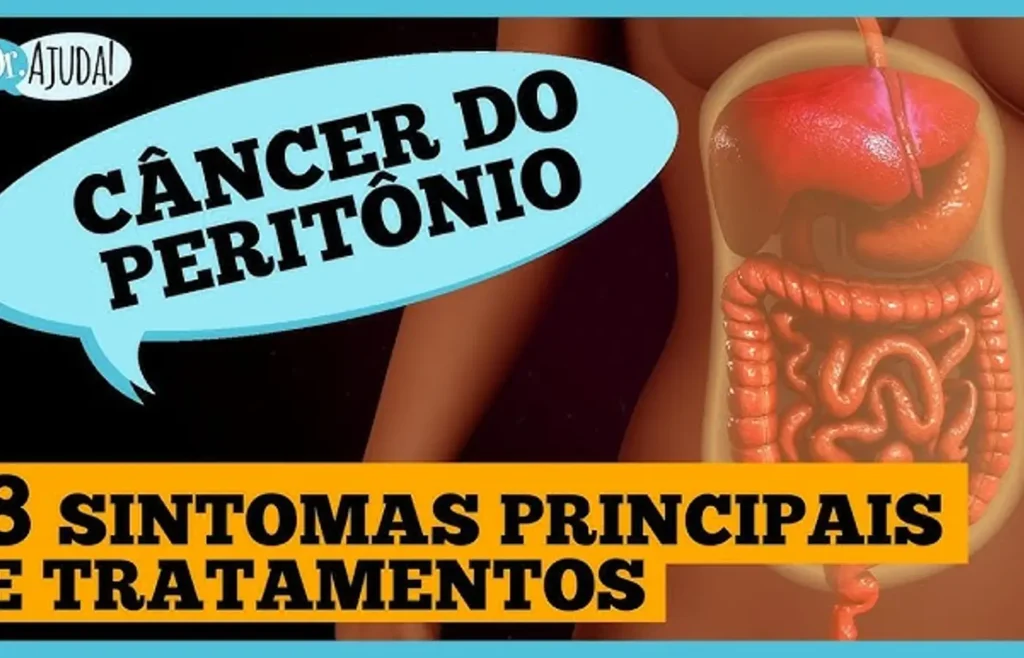 cancer-de-peritonio:-diagnostico,-tratamento-e-prognostico