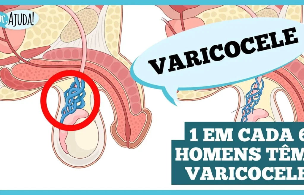 varicocele:-o-que-e-importante-saber?