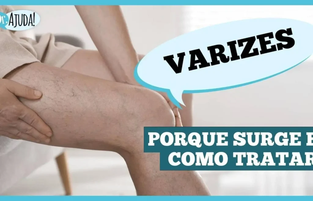 varizes:-nao-e-so-estetica-e-saude-vascular